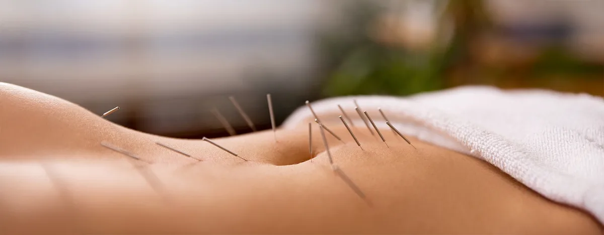 Acupuncture et Fécondation In Vitro (FIV)